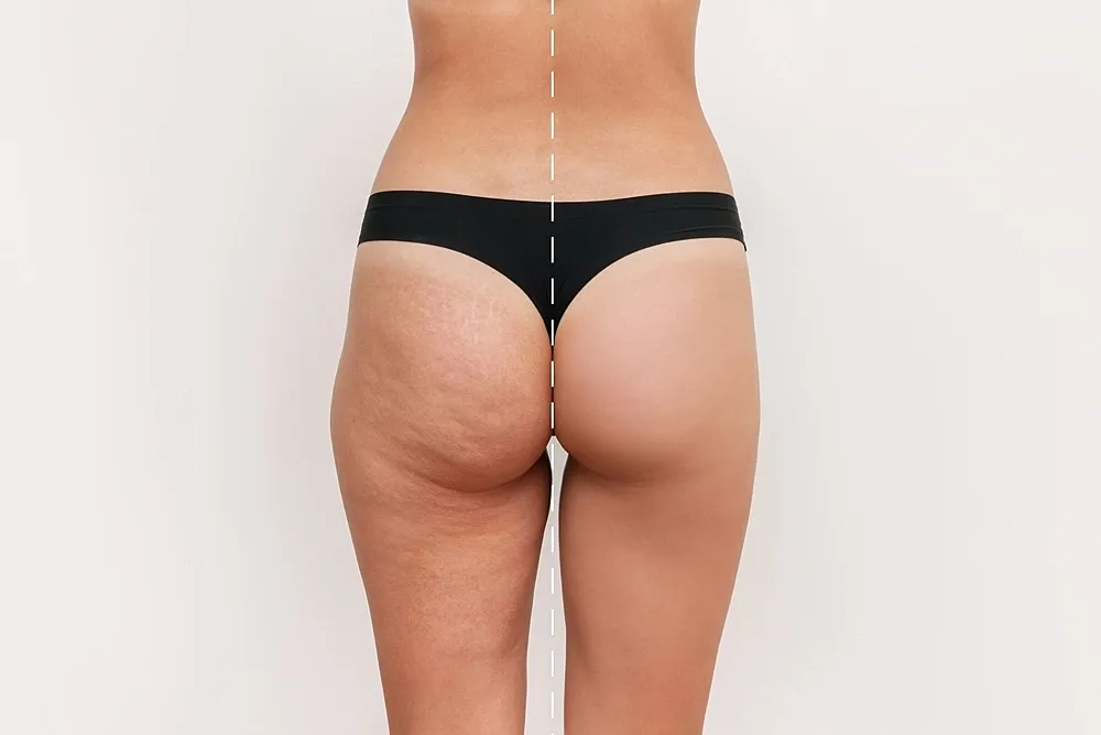 Cellfina vs Other Cellulite Treatments: A Comparative Analysis