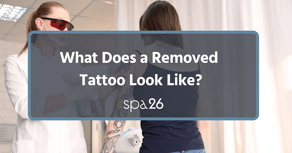 What Does a Removed Tattoo Look Like?