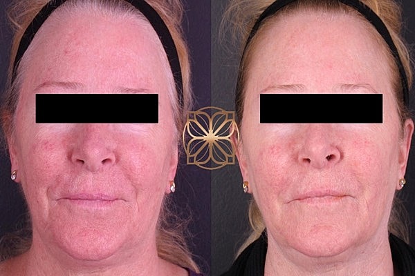 Before and after facial treatment comparison.