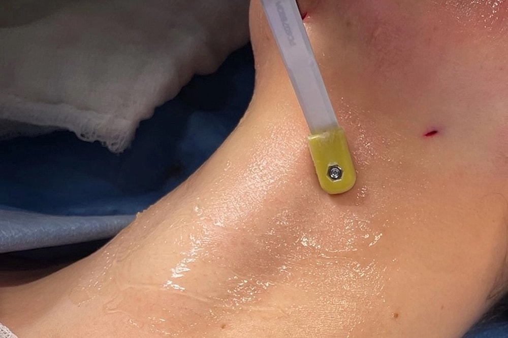 Medical procedure on a patient's neck area.