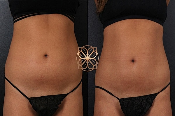 Before and after body contouring images.