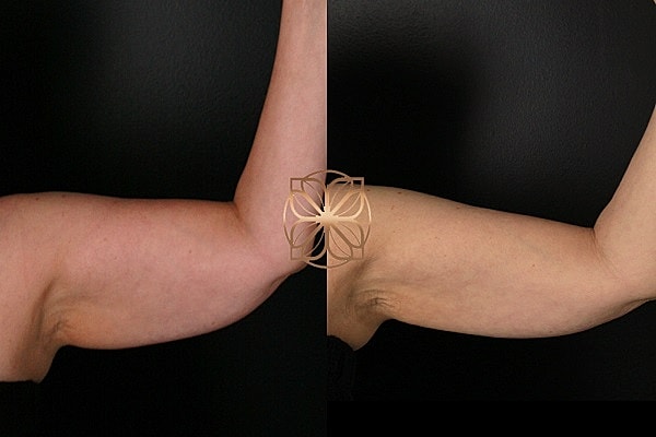 Before and after arm treatment comparison.
