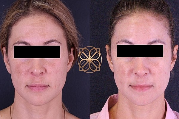 Before and after facial skin treatment comparison.
