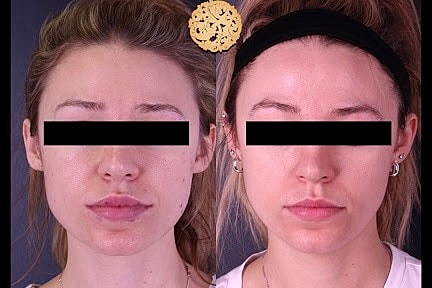 Before and after skincare treatment comparison.