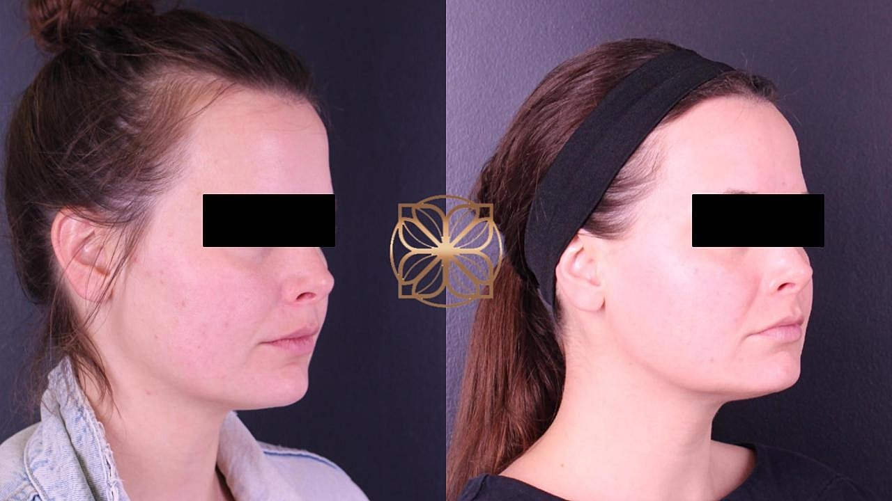 Before and after cosmetic treatment comparison.
