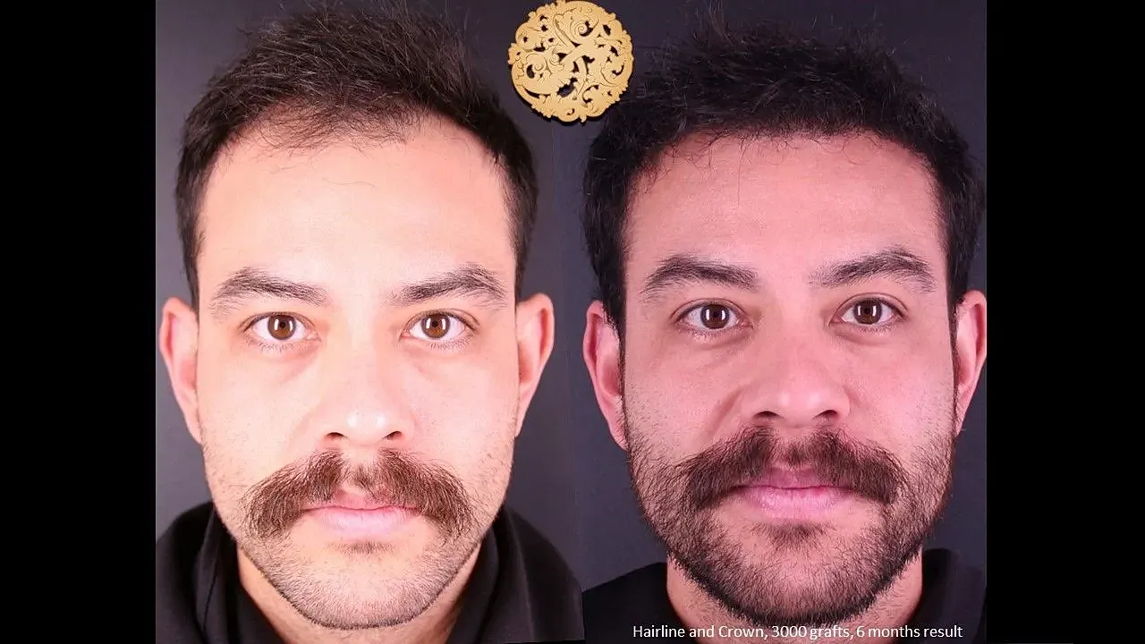 Before and after hair transplant results.