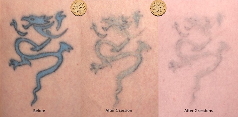 Tattoo fading progress after laser removal sessions.