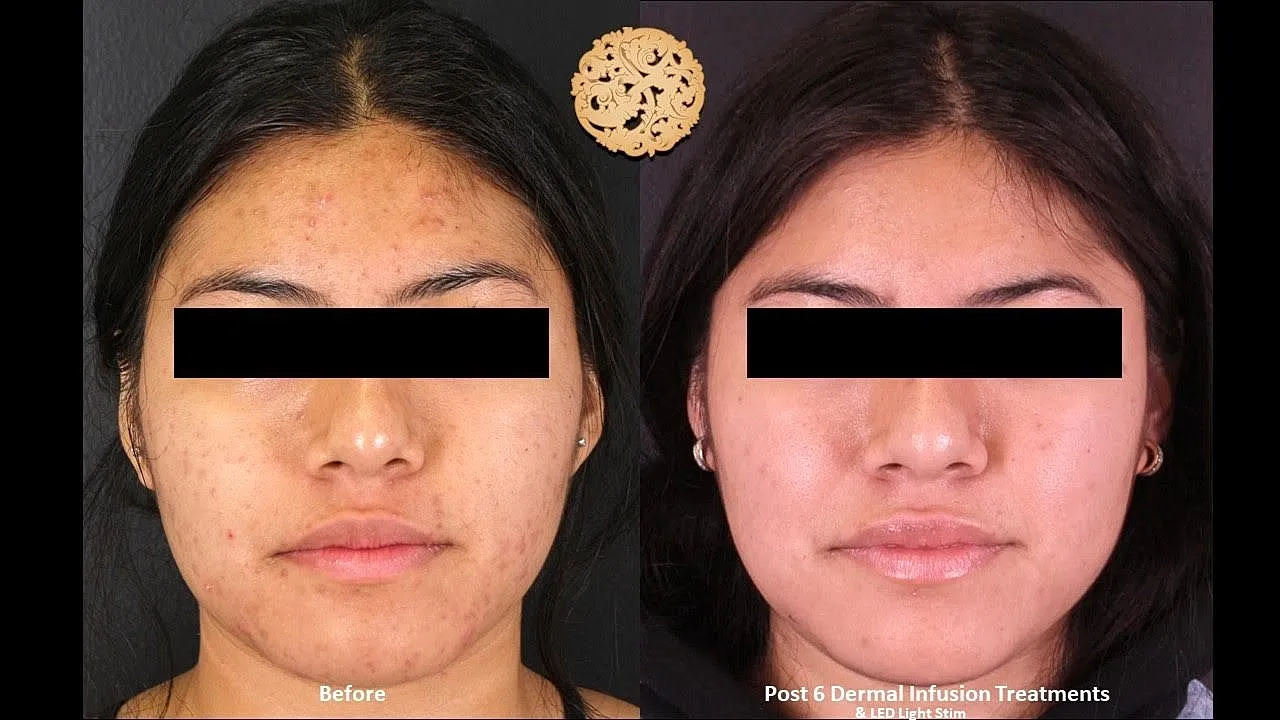 Before and after skin treatment comparison photo.