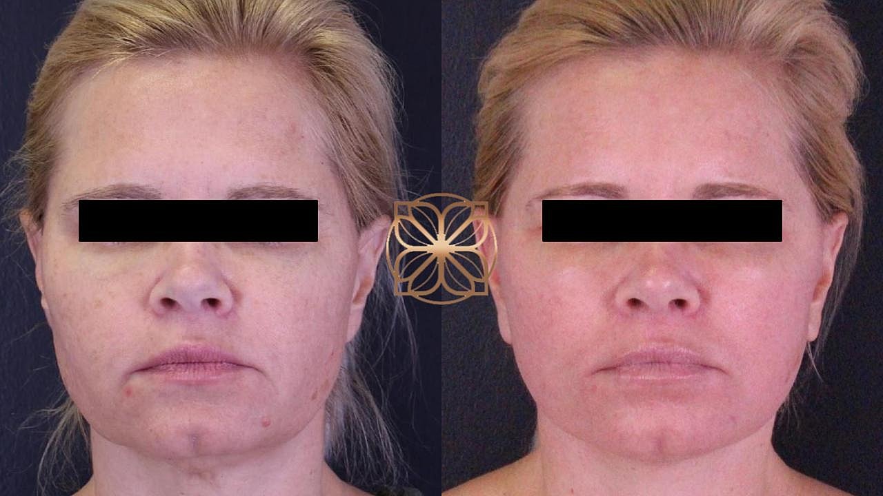 Before and after cosmetic treatment comparison.