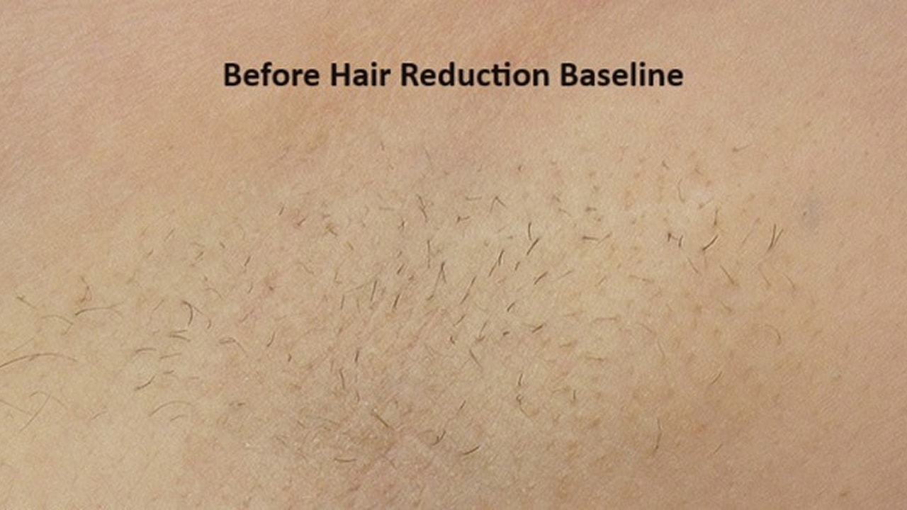 Skin with hair before reduction treatment.