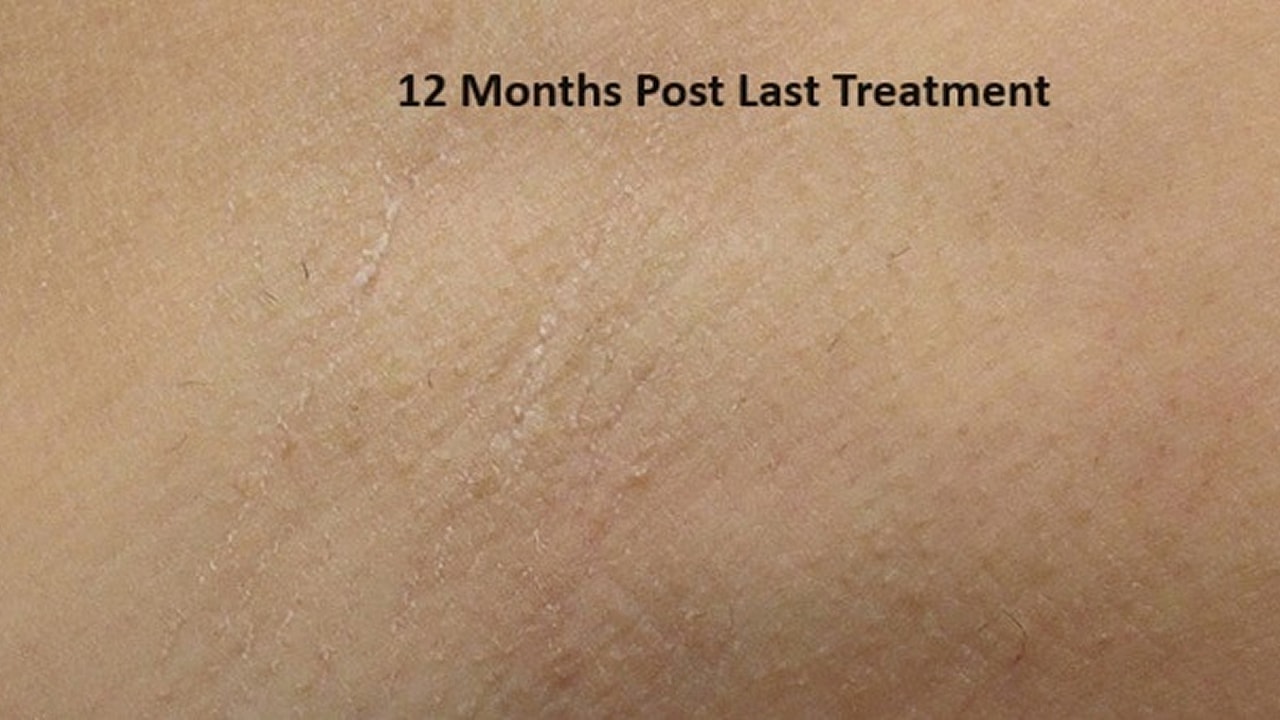 Skin appearance 12 months after last treatment.