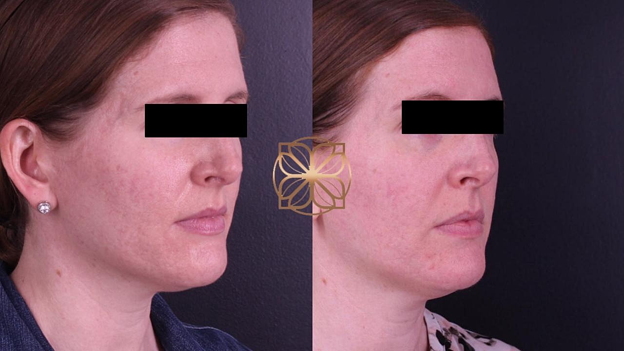 Before and after facial treatment comparison image.