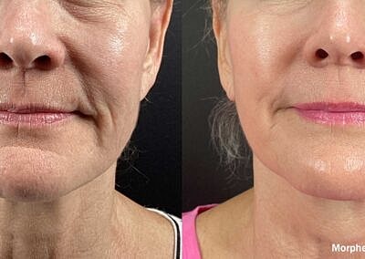 Before and after skin treatment comparison on woman.