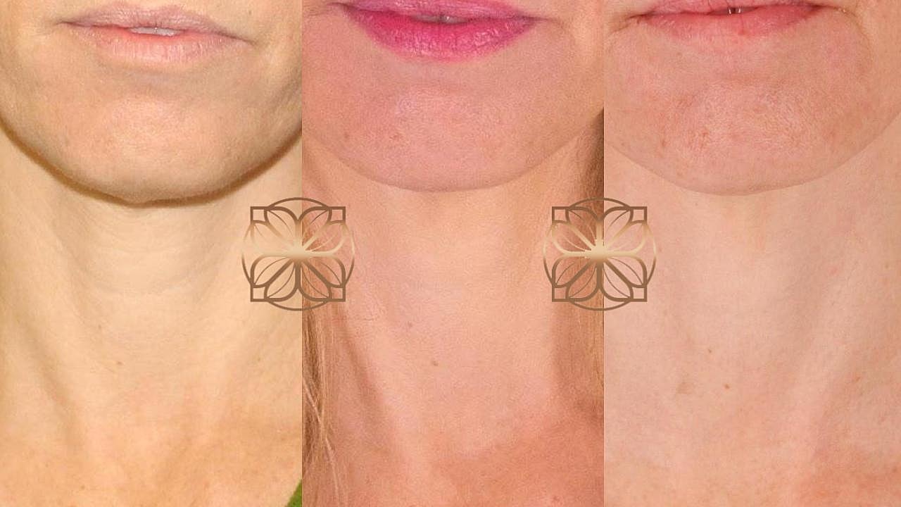 Before and after neck skin treatment comparison.