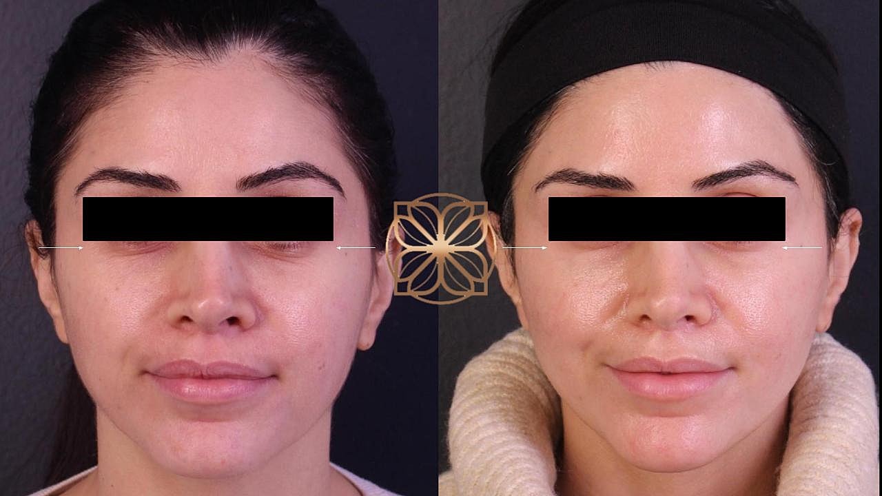 Before and after facial treatment comparison.