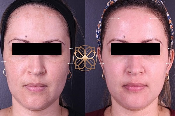 Before and after facial treatment comparison image.