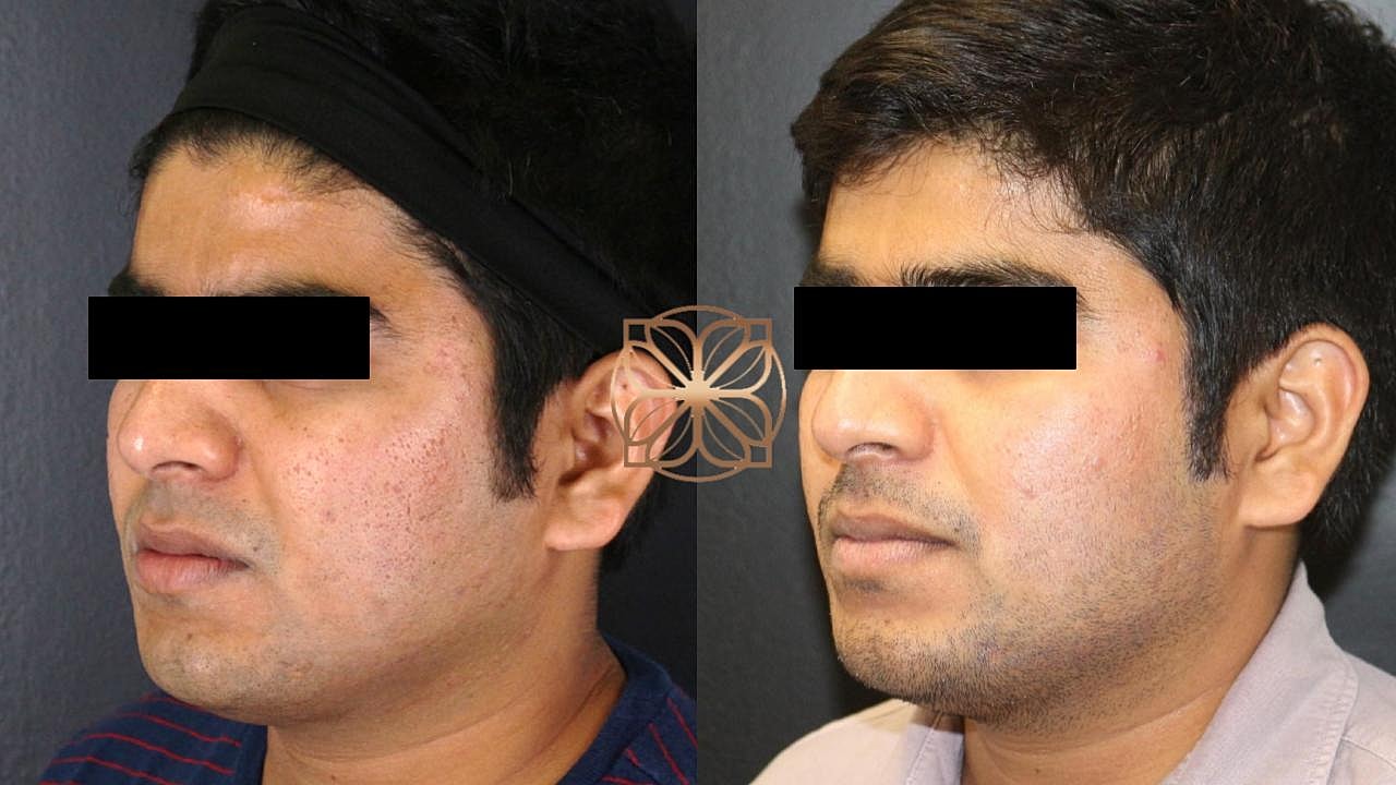 Before and after facial treatment comparison.