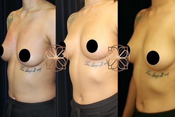 Before and after breast enhancement photos.