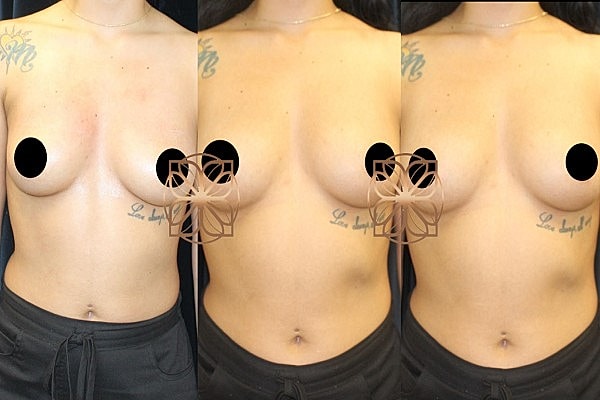 Before and after breast augmentation photos.