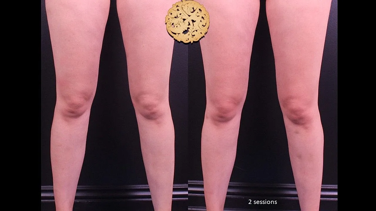 Before and after thigh treatment comparison photo.