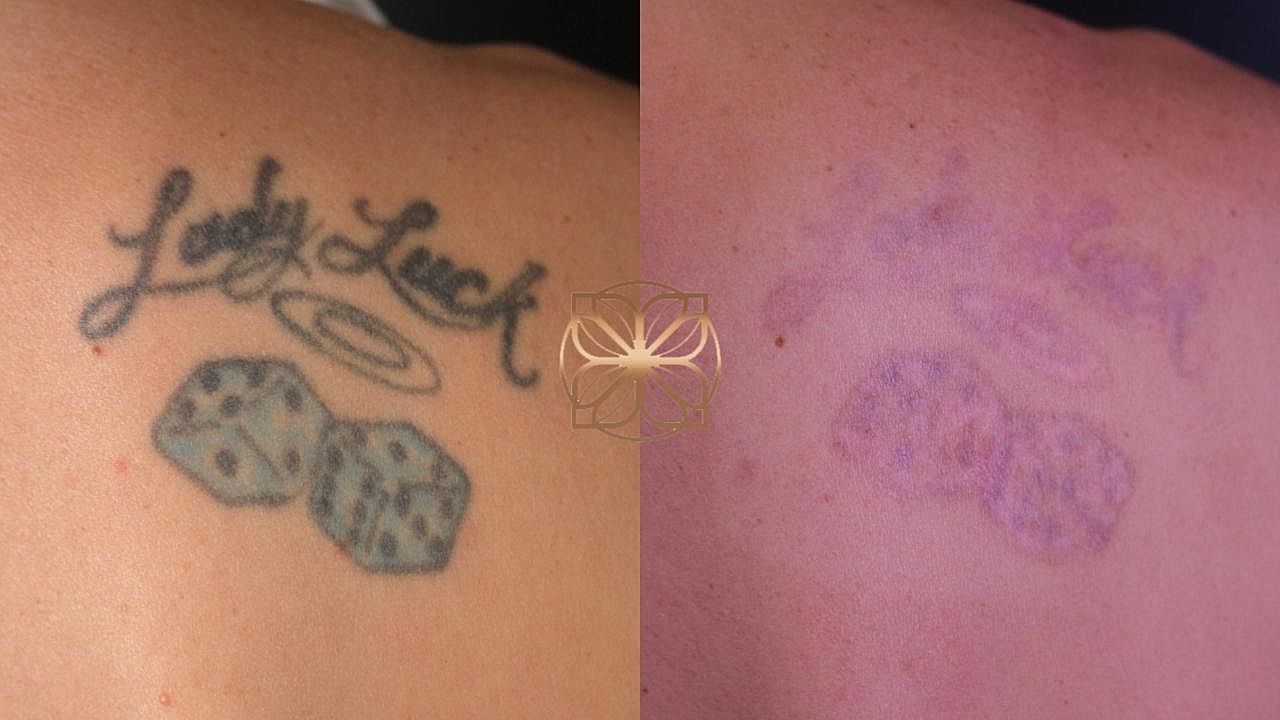 Tattoo fading before and after removal process.