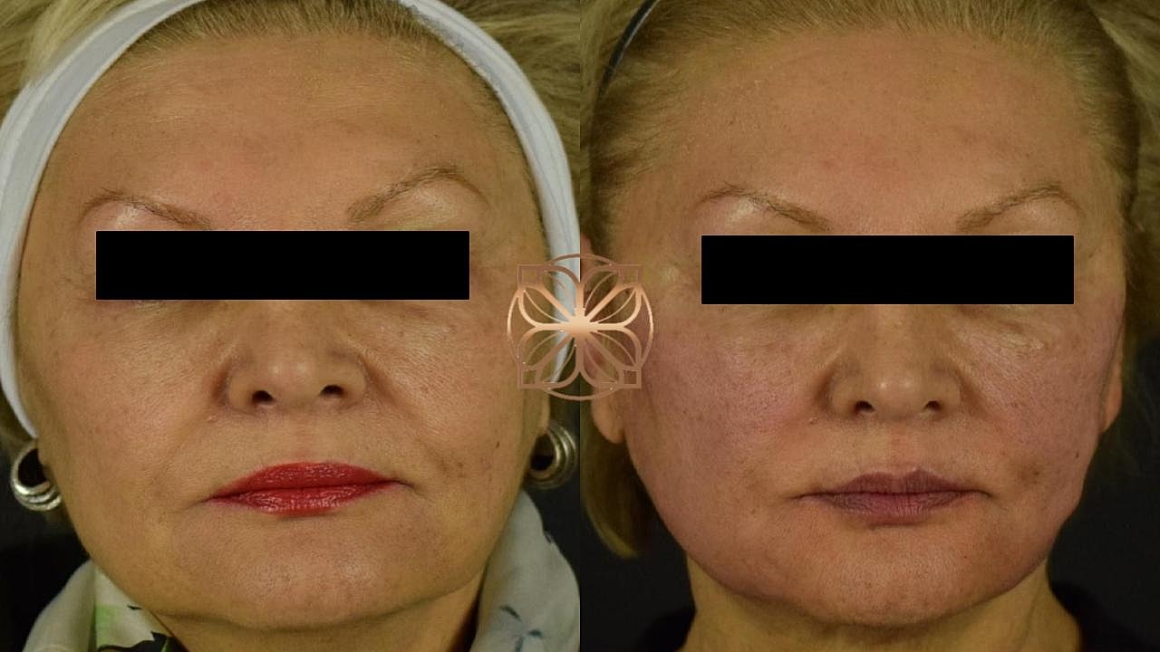 Before and after facial aesthetic treatment comparison.