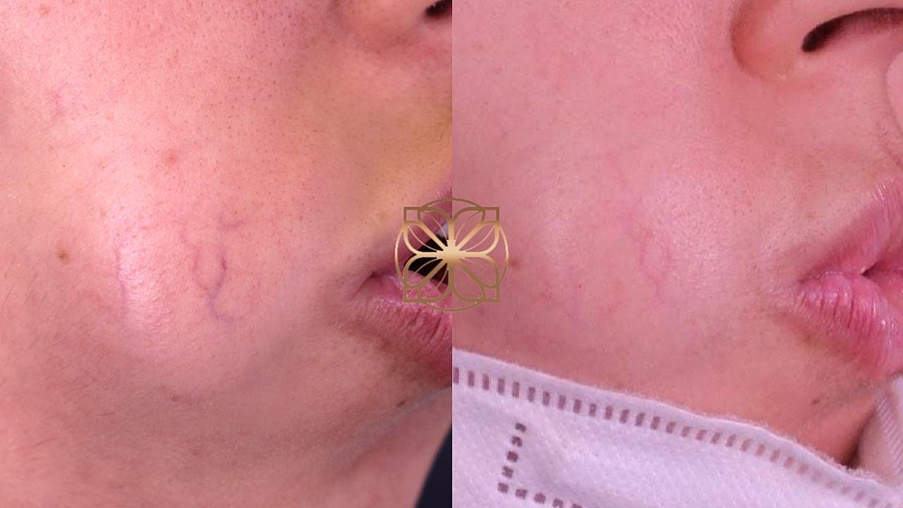 Before and after skin treatment comparison.