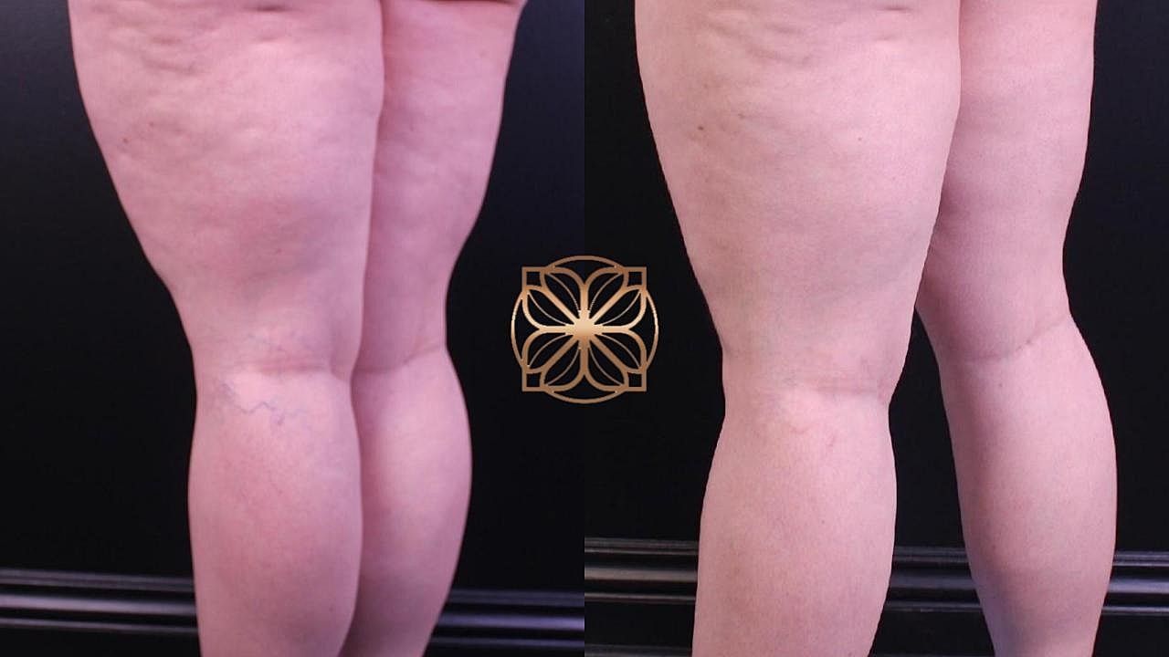 Before and after leg treatment comparison.