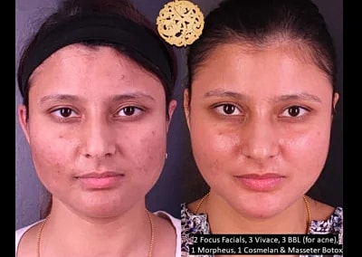 Before and after skin treatment results.