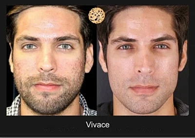 Before and after facial treatment comparison.