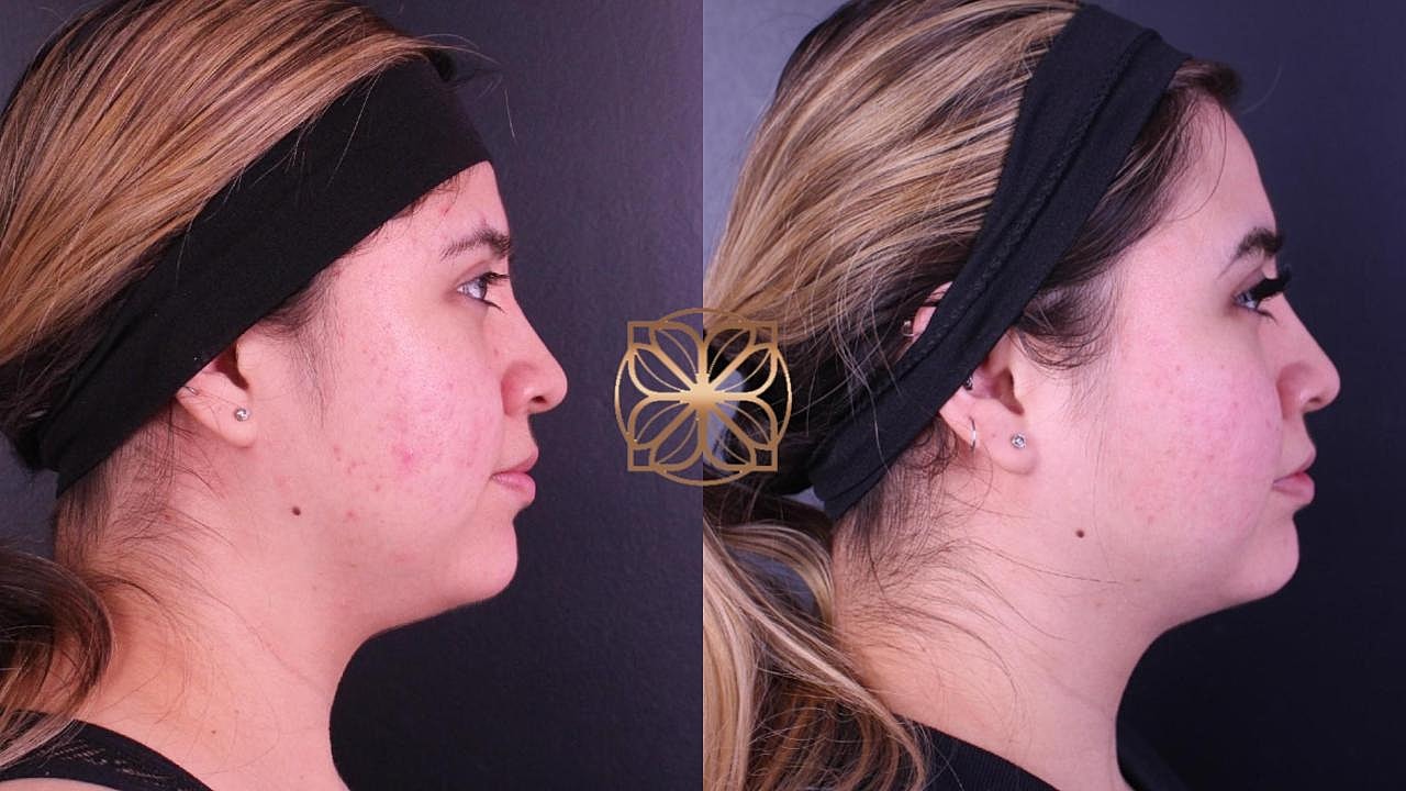 Contouring Gallery Before & After