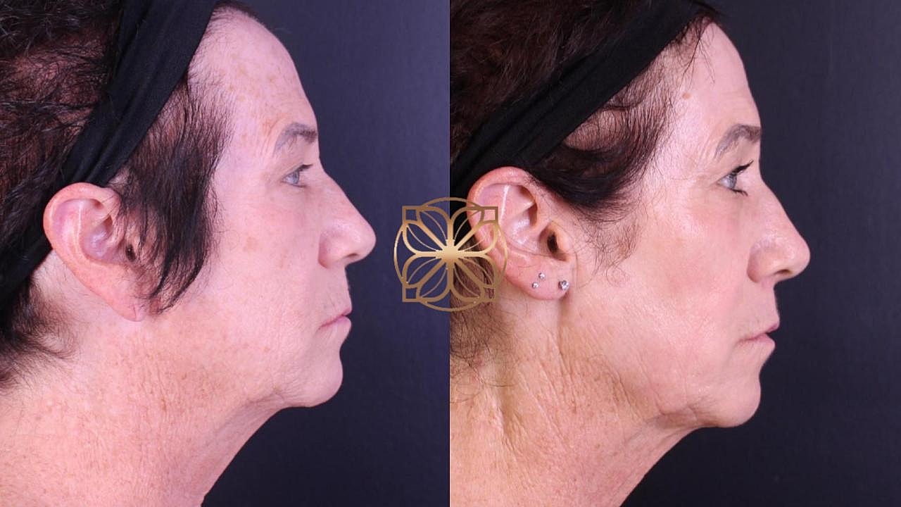Contouring Gallery Before & After