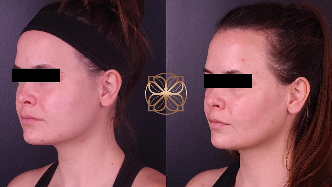 Contouring Gallery Before & After