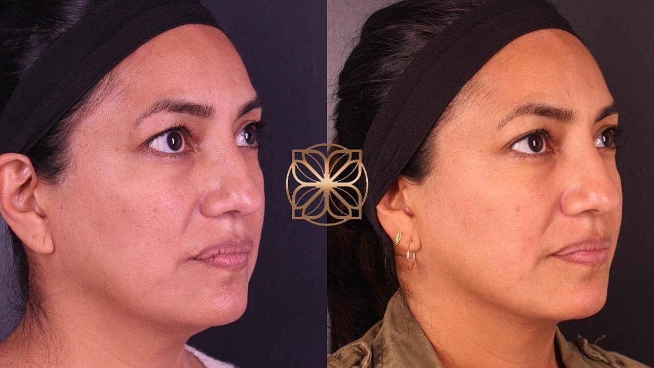 Contouring Gallery Before & After