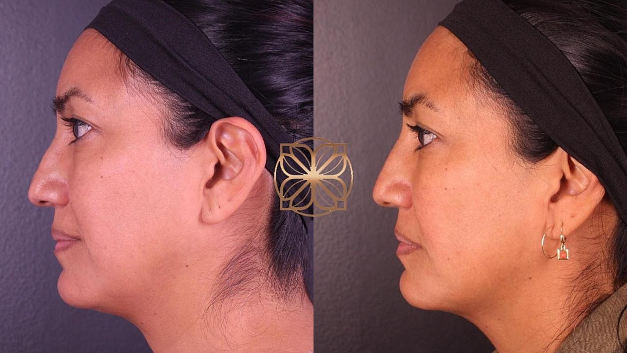 Contouring Gallery Before & After
