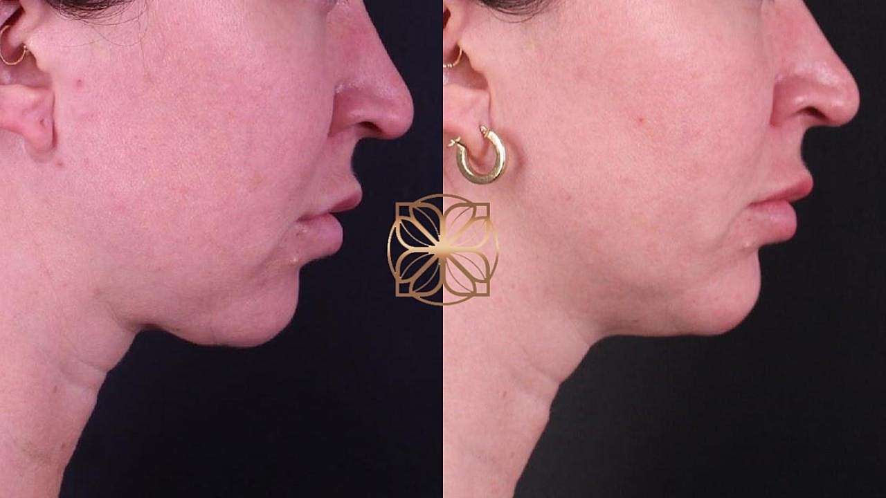 Contouring Gallery Before & After