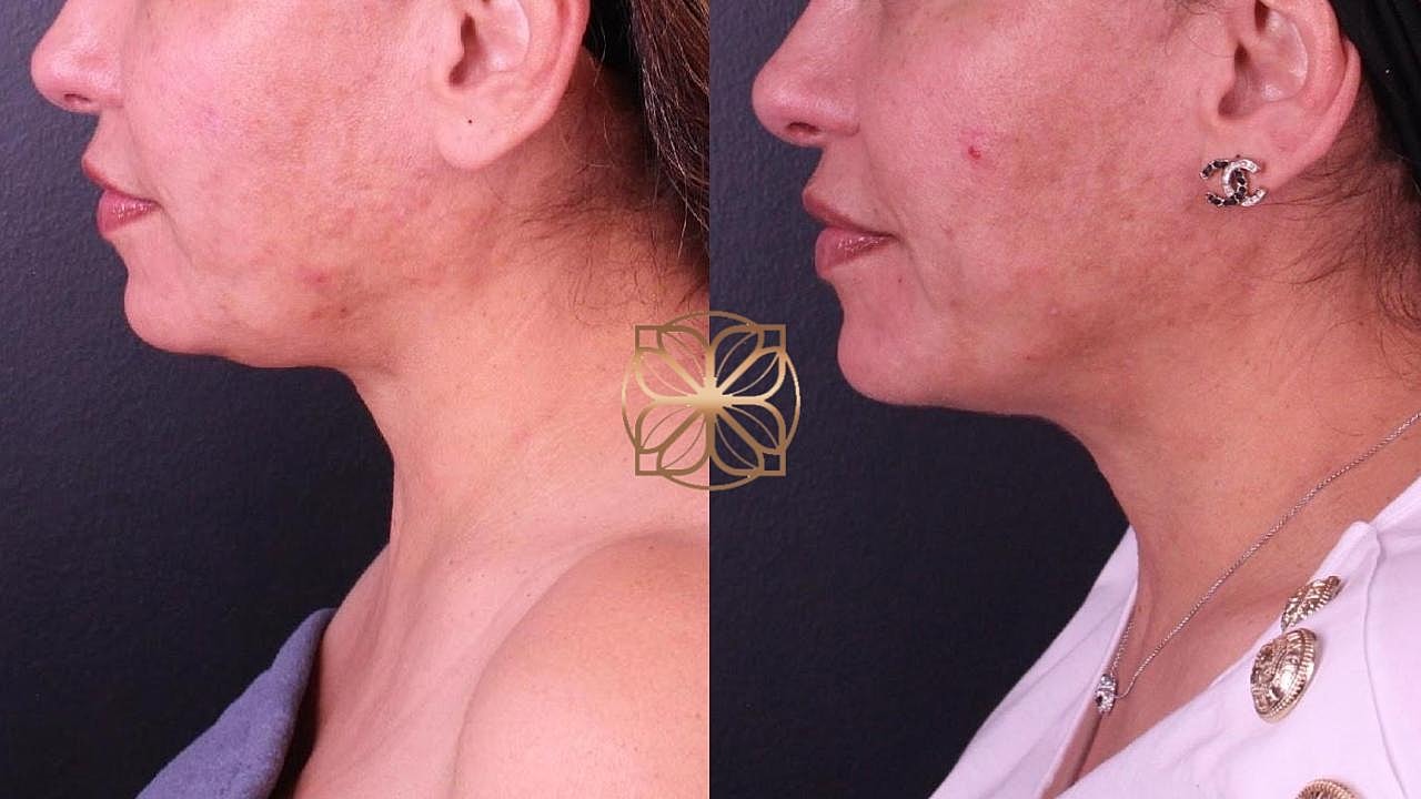 Contouring Gallery Before & After