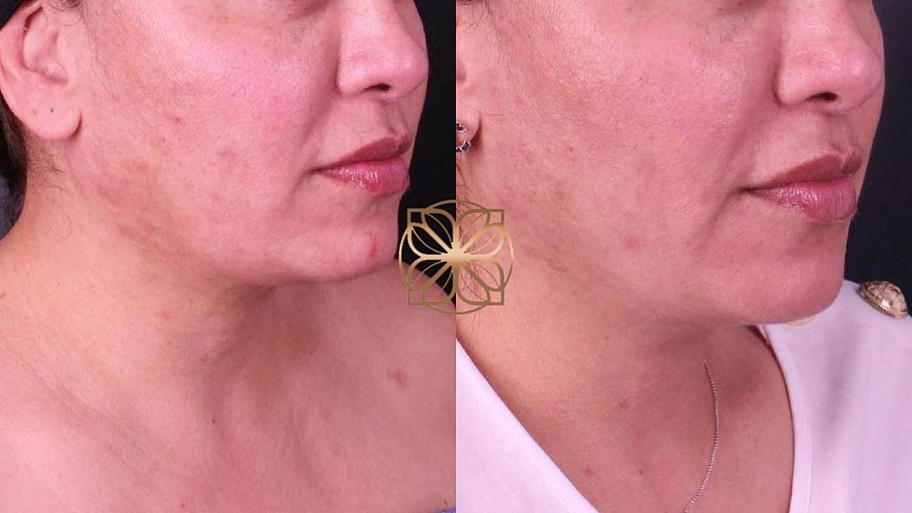 Contouring Gallery Before & After