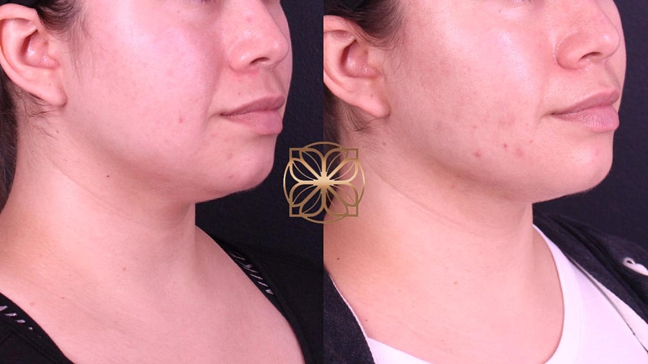 Contouring Gallery Before & After