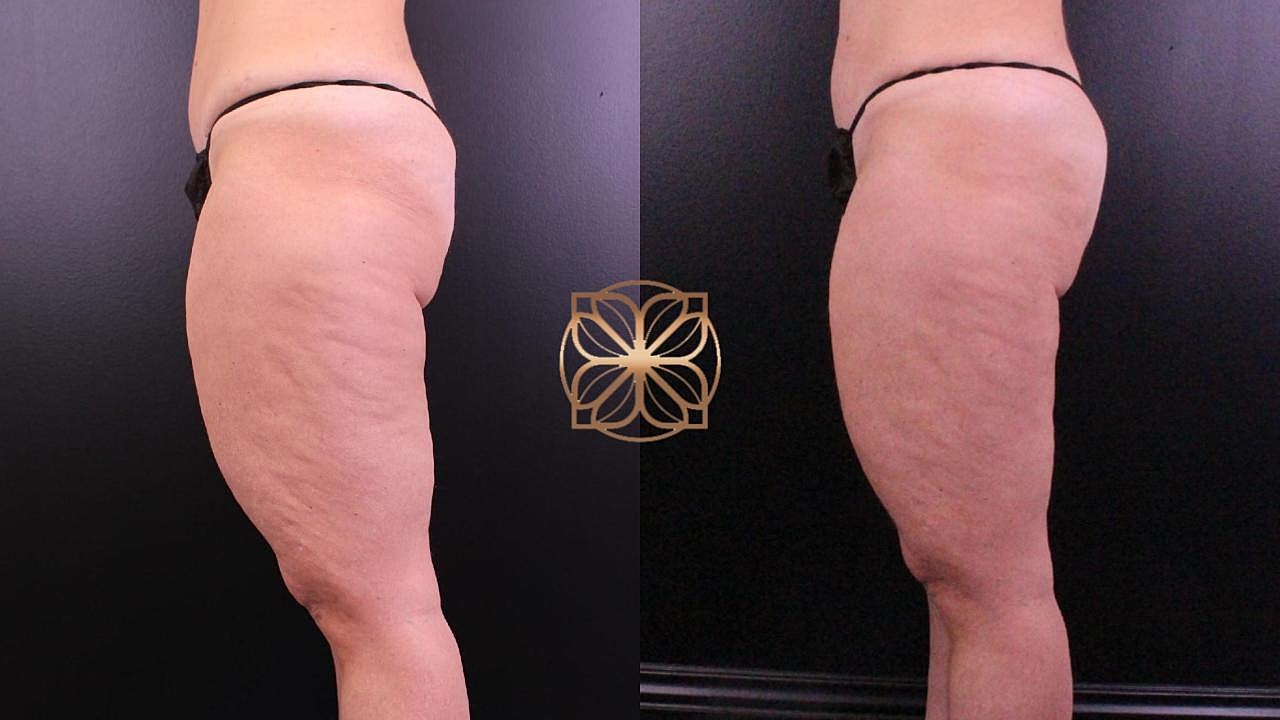 Contouring Gallery Before & After