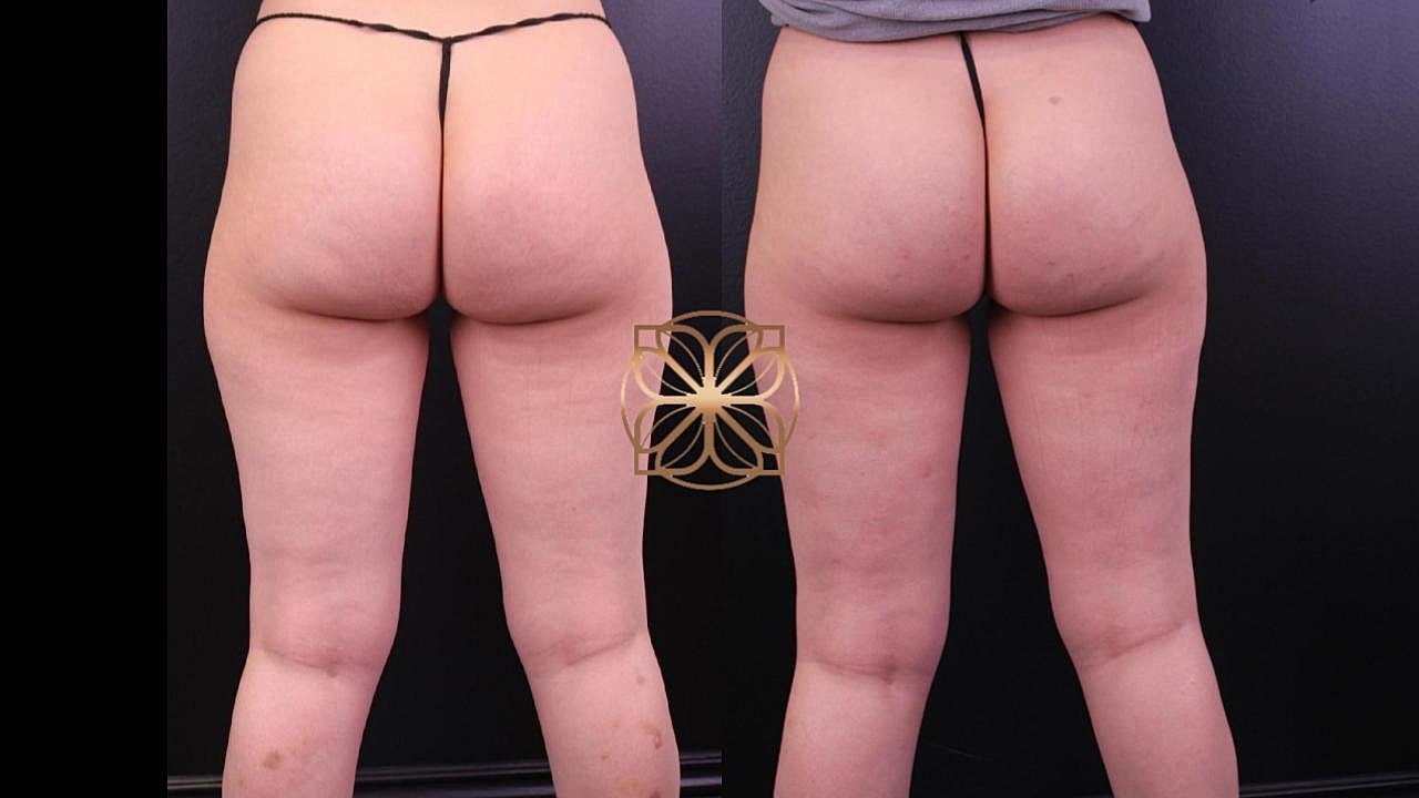 Contouring Gallery Before & After