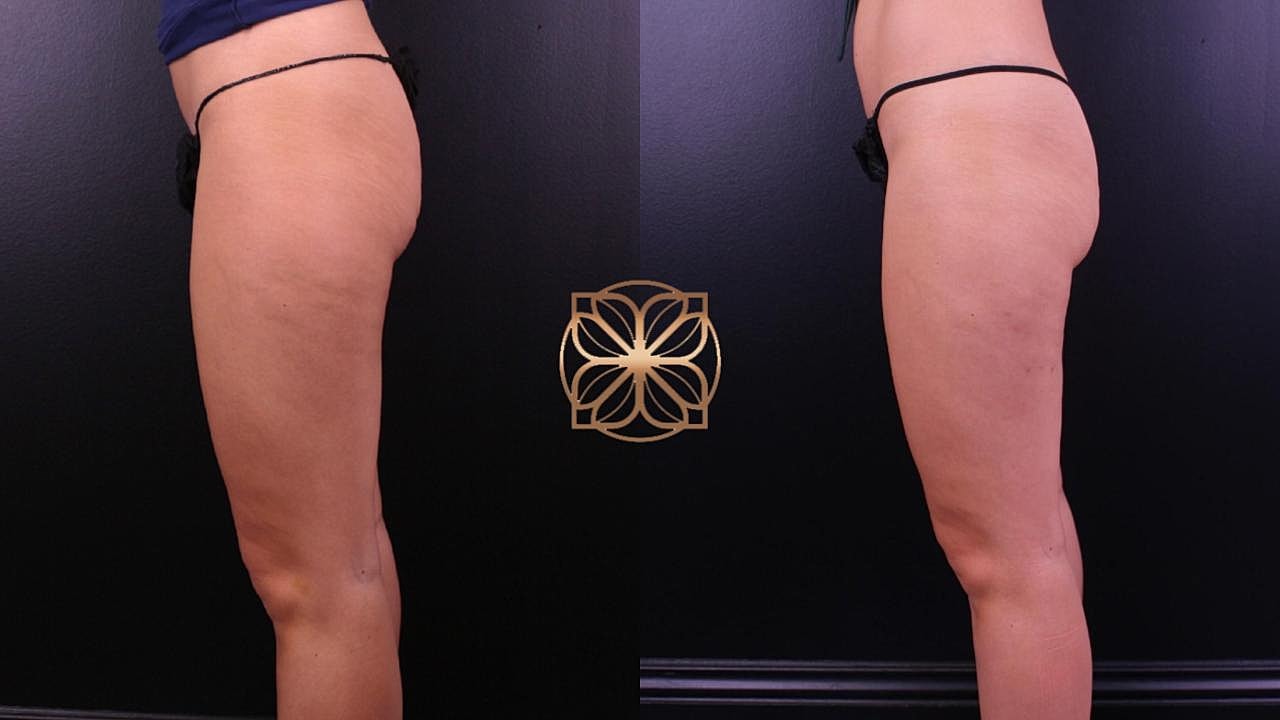 Contouring Gallery Before & After