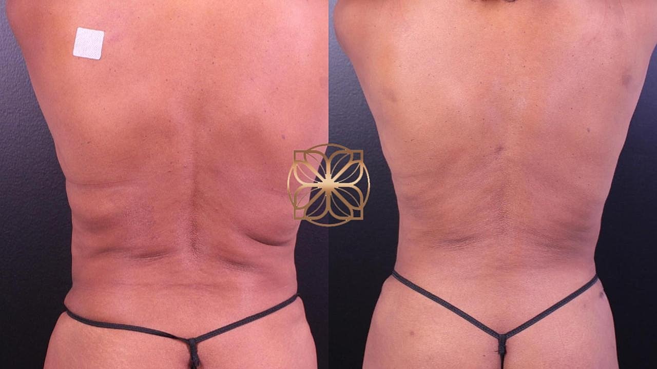 Contouring Gallery Before & After