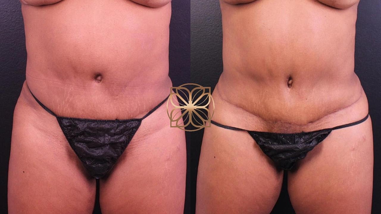 Contouring Gallery Before & After