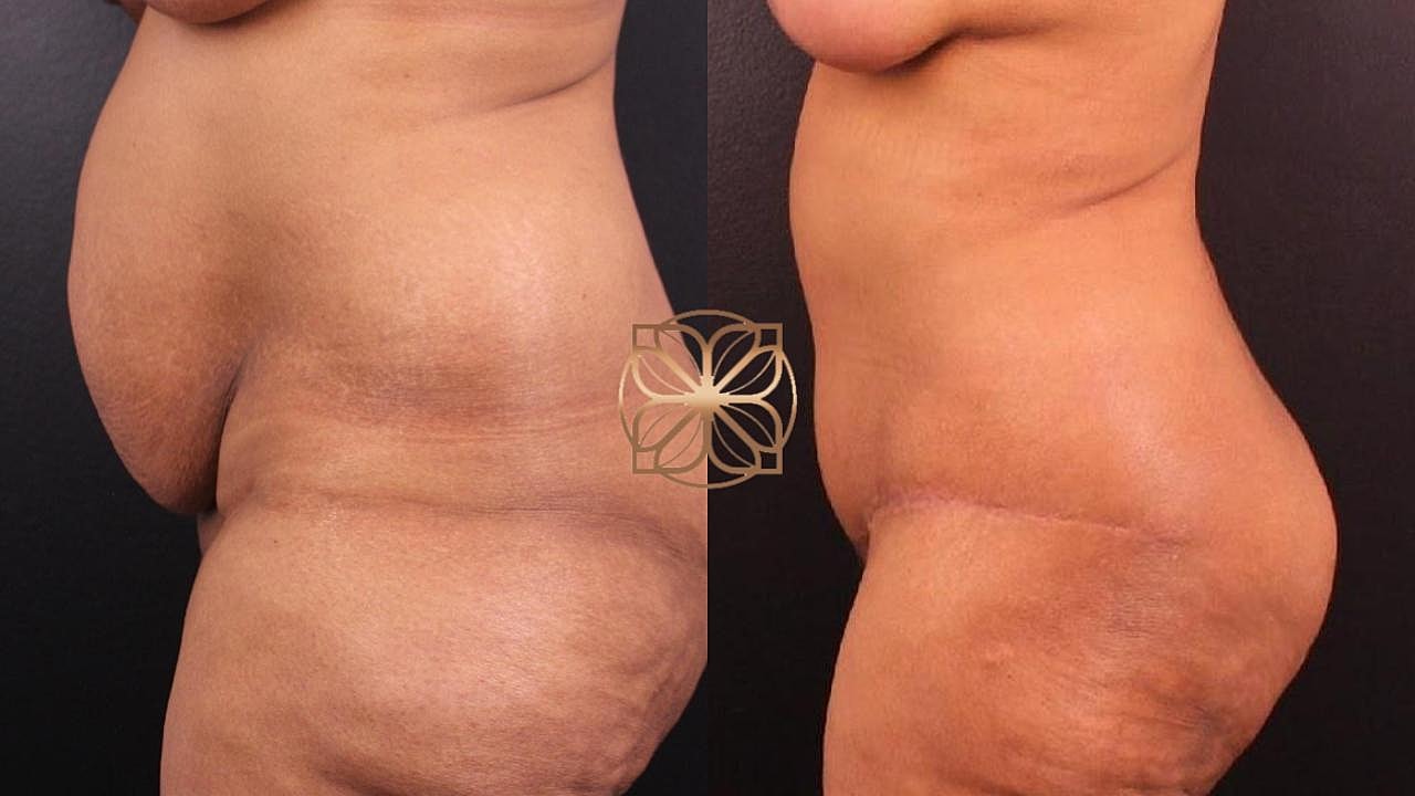 Contouring Gallery Before & After