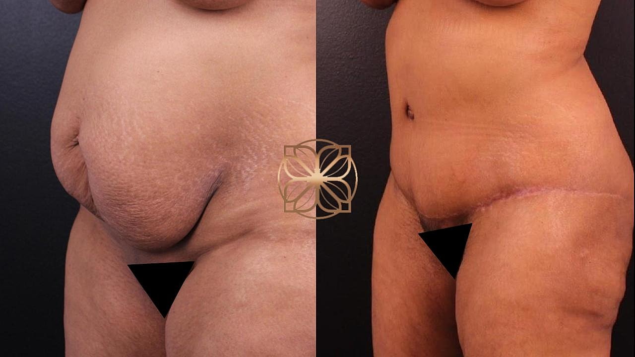 Contouring Gallery Before & After