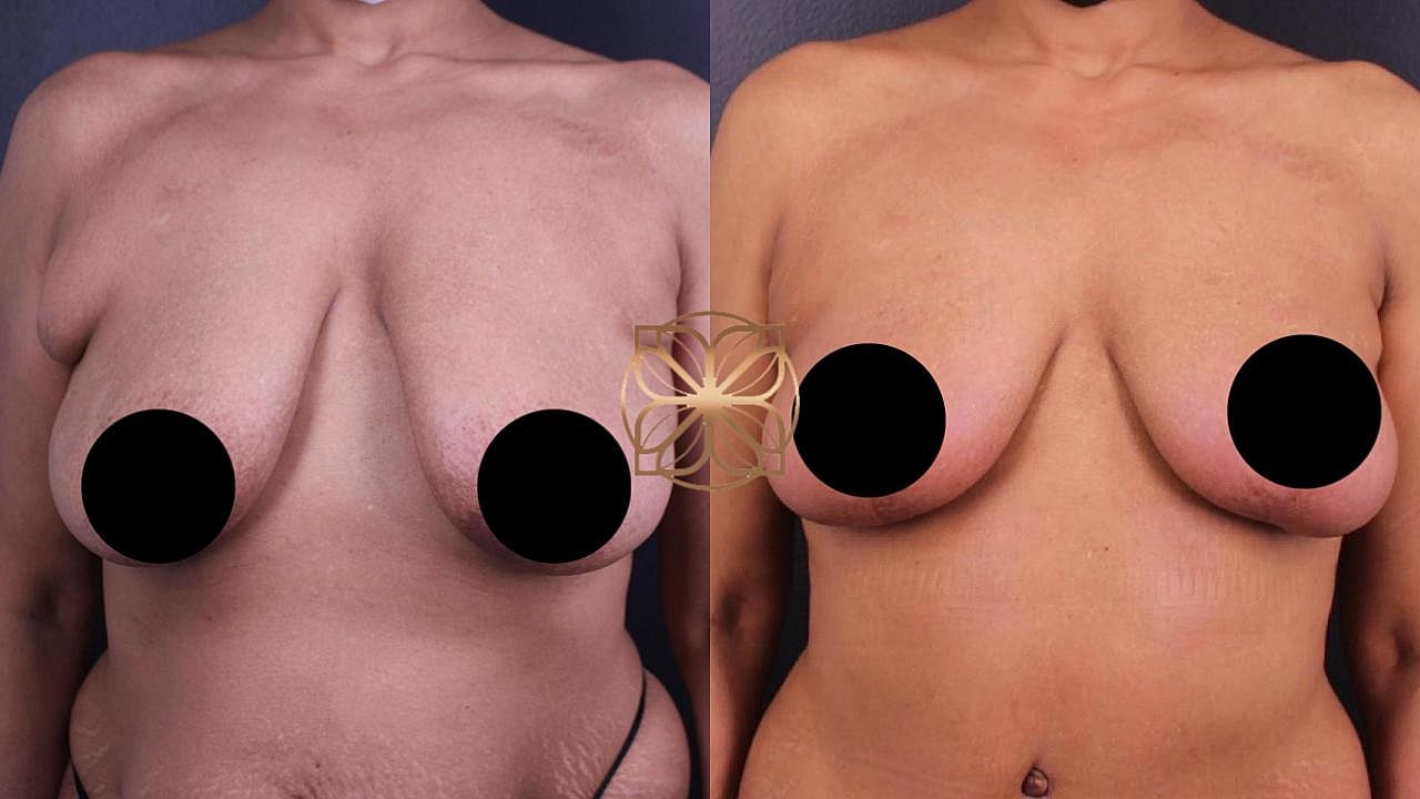 Contouring Gallery Before & After