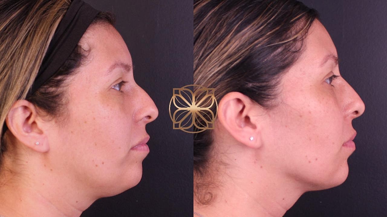 Coolsculpting Gallery Before & After