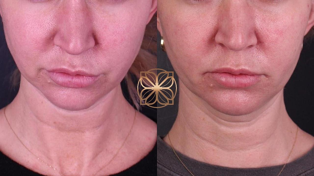 Coolsculpting Gallery Before & After