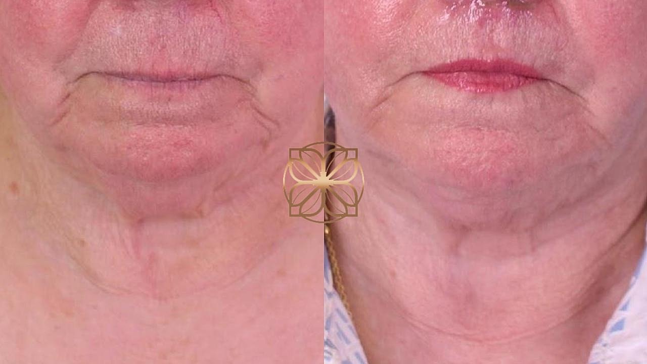 Coolsculpting Gallery Before & After